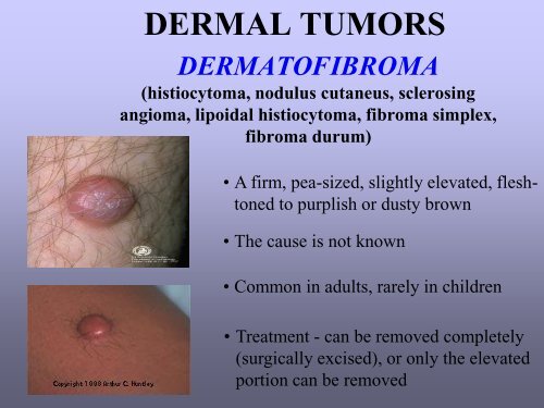 Benign skin tumor ( non – vascular )