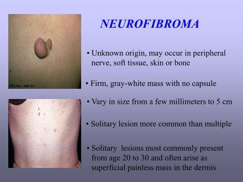 Benign skin tumor ( non – vascular )