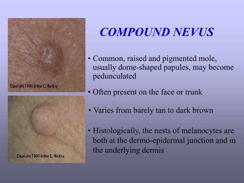 Benign skin tumor ( non – vascular )