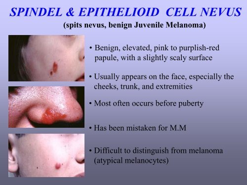 Benign skin tumor ( non – vascular )