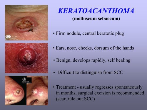 Benign skin tumor ( non – vascular )