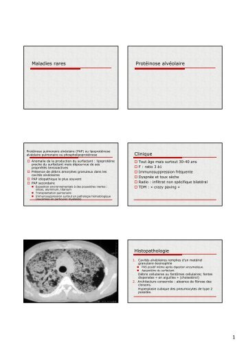 Maladies rares Protéinose alvéolaire Clinique Histopathologie - AFIAP