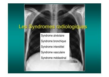 Les Syndromes radiologiques - Soutien Pneumologique International