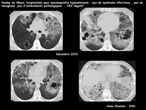 LM CC thorax carcinome bronchiolo-alvéolaire - RADIOLOGIE ...