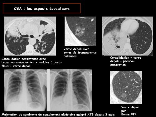 LM CC thorax carcinome bronchiolo-alvéolaire - RADIOLOGIE ...