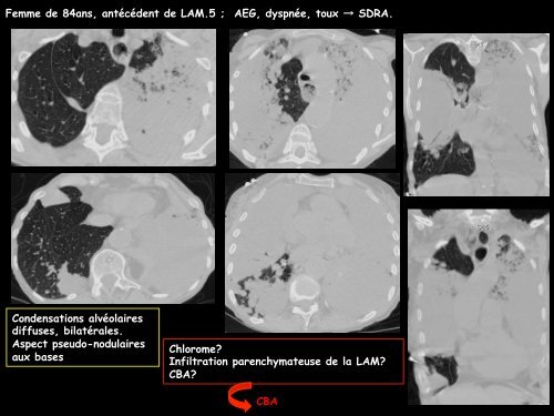 LM CC thorax carcinome bronchiolo-alvéolaire - RADIOLOGIE ...