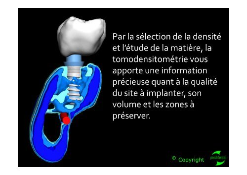 La tomodensitométrie en PDF - Positdental