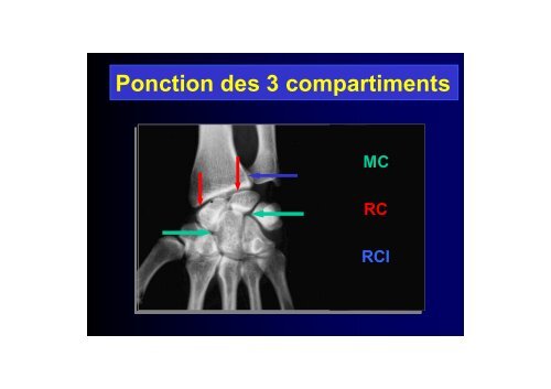 EVALUATION CLINIQUE ET IMAGERIE DU POIGNET ...