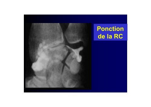 EVALUATION CLINIQUE ET IMAGERIE DU POIGNET ...