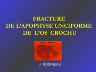 FRACTURES DE L'APOPHYSE UNCIFORME DE L'OS CROCHU