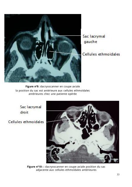 Embryologie du système lacrymal - Faculté de Médecine et de ...