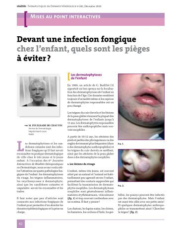 Devant une infection fongique chez l'enfant, quels sont les pièges à ...