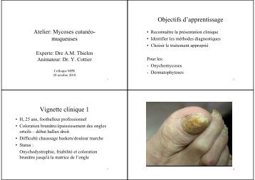 Mycoses muco-cutanées - HUG