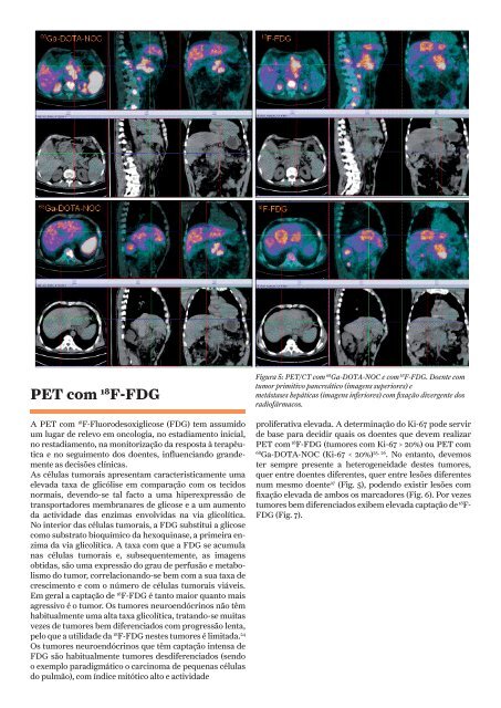 Medicina Nuclear e Tumores Neuroendocrinos