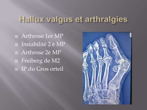 L'Hallux Valgus : Prise en charge médicale - Cofemer