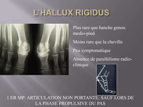 L'Hallux Valgus : Prise en charge médicale - Cofemer