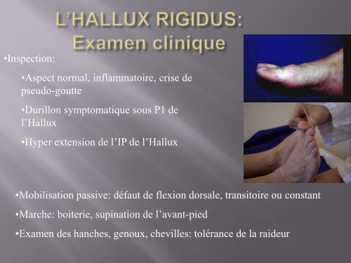 L'Hallux Valgus : Prise en charge médicale - Cofemer