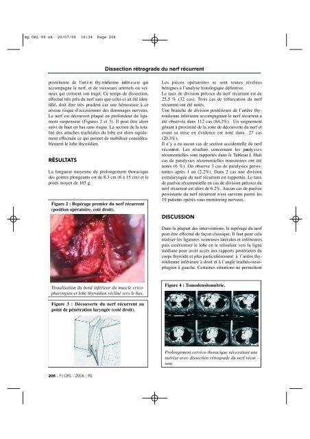 Dissection rétrograde du nerf récurrent dans la chirurgie thryoidienne