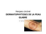 Dermatophytie