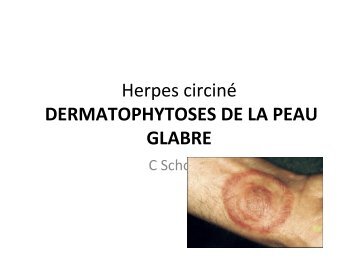 Dermatophytie