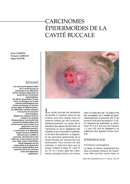 carcinomes epidermoides de la cavite buccale information dentaire