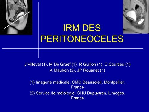 IRM DES PERITONEOCELES