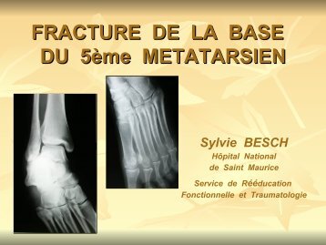 Fractures de la base du 5ème métatarsien