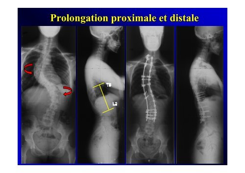 Correction de l'alignement sagittal de la jonction thoraco-lombaire ...