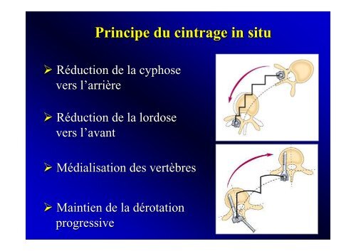 Correction de l'alignement sagittal de la jonction thoraco-lombaire ...