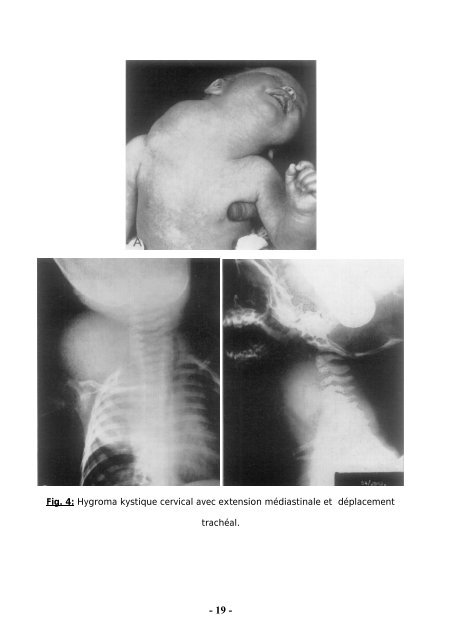 LYMPHANGIOME KYSTIQUE CHEZ L'ENFANT - Faculté de ...