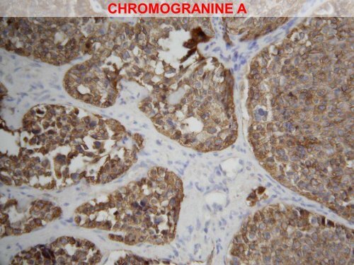 Tumeur thyroidienne - epathologies