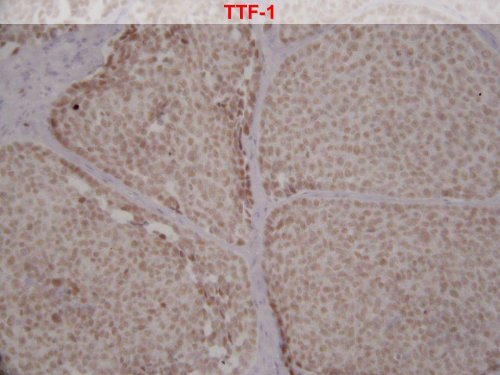 Tumeur thyroidienne - epathologies