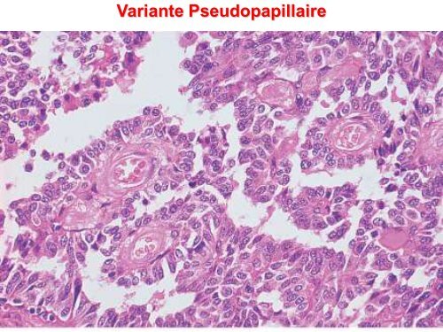 Tumeur thyroidienne - epathologies