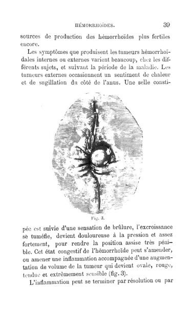 maladies du rectum