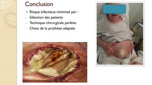 Comment s'infecte une prothèse pariétale ? - chirurgie viscérale de l ...