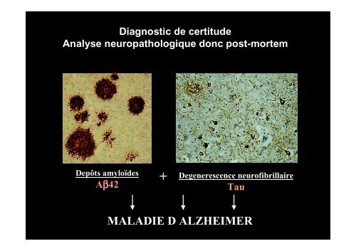 Classification des Démences