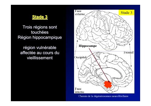 Classification des Démences