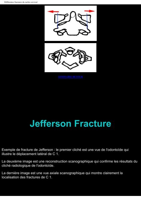 Différentes fractures du rachis cervical