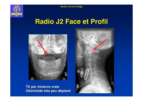 Fracture de l'odontoïde oblique dans le plan frontal. - ClubOrtho.fr