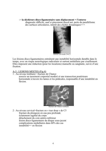 Traumatologie du rachis - Campus de Neurochirurgie