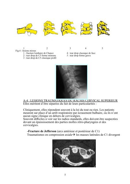 Traumatologie du rachis - Campus de Neurochirurgie