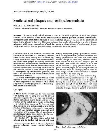 Senile scleral plaques and senile scleromalacia - British Journal of ...