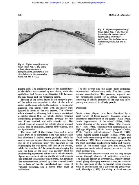 Senile scleral plaques and senile scleromalacia - British Journal of ...