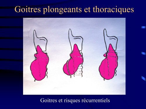 Goitres plongeants et thoraciques - Association Francophone de ...