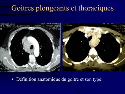 Goitres plongeants et thoraciques - Association Francophone de ...