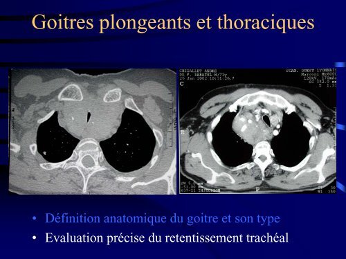 Goitres plongeants et thoraciques - Association Francophone de ...