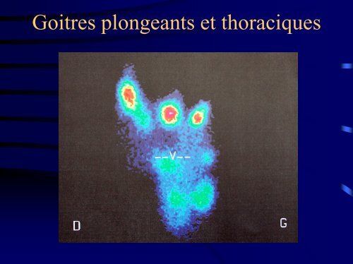 Goitres plongeants et thoraciques - Association Francophone de ...