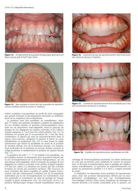 Dispositifs interocclusaux - Belbacha Dental