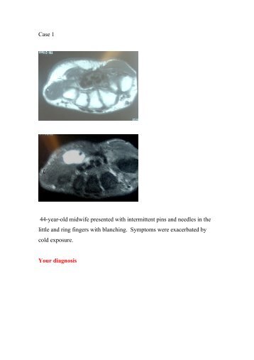 Case 1 Hypothenar swelling - Bonefix