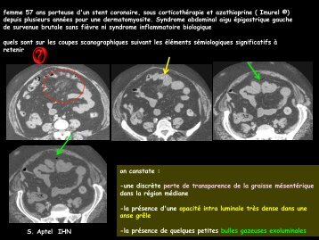 D CC dig perforations du grêle blisters médicamenteux